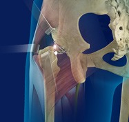 Chris Hoedt, MD - Orthopaedic Surgeon - Hip & Knee Reconstruction Specialist - Publications